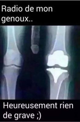 Radio de mon genoux heureusemen rien de grave
